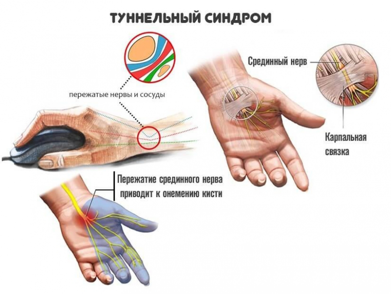 Диета При Туннельном Синдроме