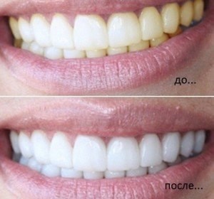​Натуральное отбеливание зубов