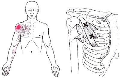 ​Малая грудная мышца или источник боли, о котором вы не догадываетесь