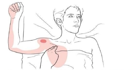 ​Малая грудная мышца или источник боли, о котором вы не догадываетесь
