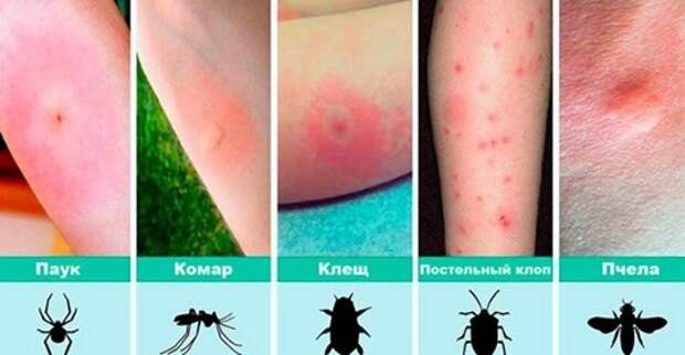 12 видов укусов насекомых и что делать при каждом из них (часть 1)