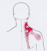 Карта точек боли в теле и точек напряжения мышц (триггеры)