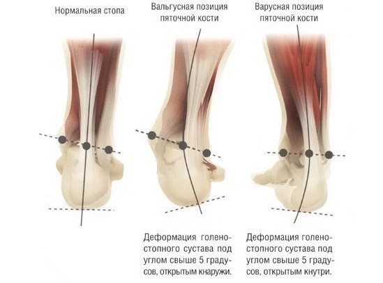 ​Лечебная физкультура при вальгусной деформации стоп