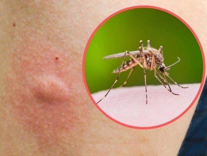 ​Как легко снять зуд от укусов комаров