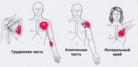 Карта точек боли в теле и точек напряжения мышц (триггеры)