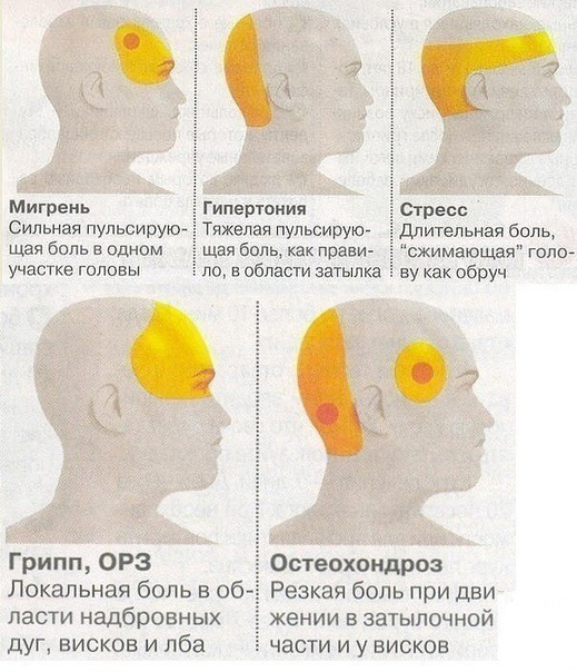 Зоны локализации головной боли и ее причины