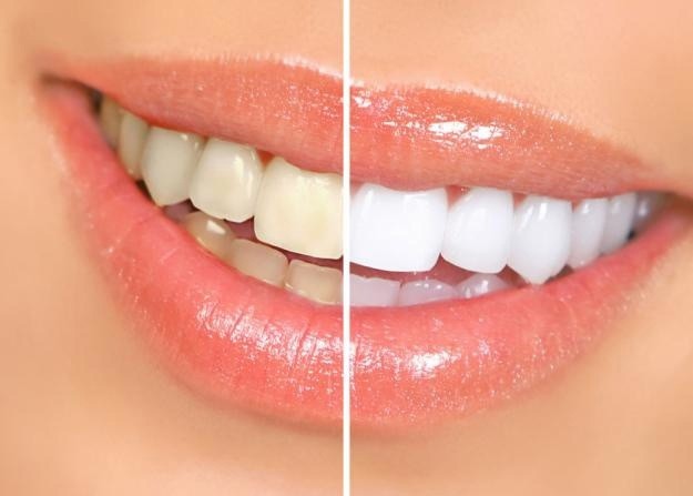 ​Как отбелить зубы и не нанести им вреда