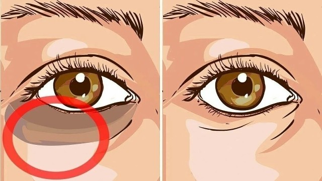 Мешки под глазами сойдут с этим рецептом Мешки под глазами сойдут с этим рецептом