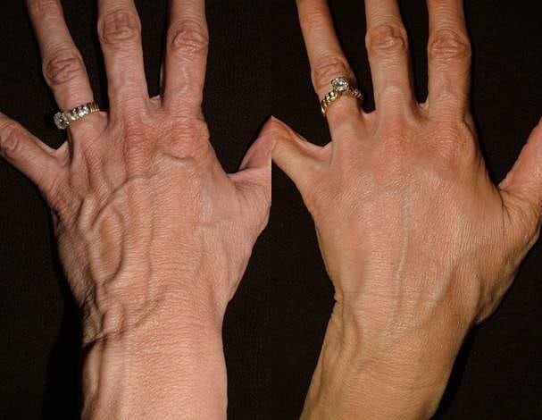 Невероятно быстрое омоложение кожи рук