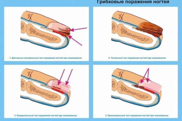 ​Как вылечить грибок на ногтях