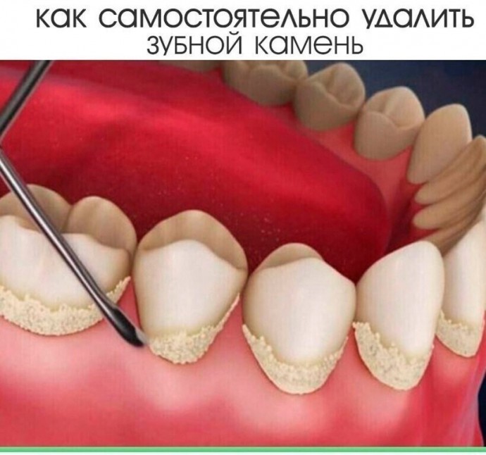 ​Как самостоятельно удалить зубной камень