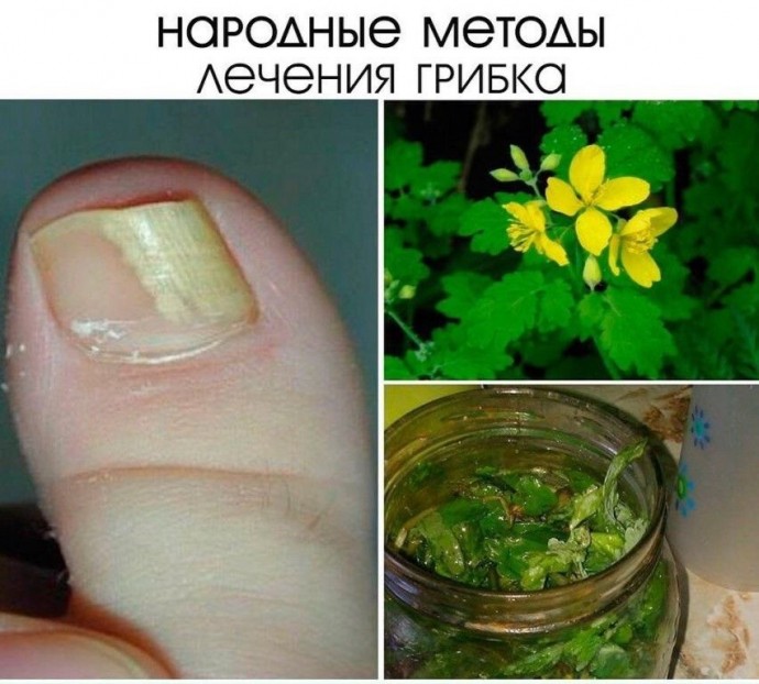 Народные методы лечения грибка