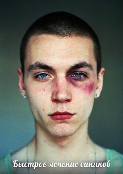Быстрое лечение синяков Быстрое лечение синяков