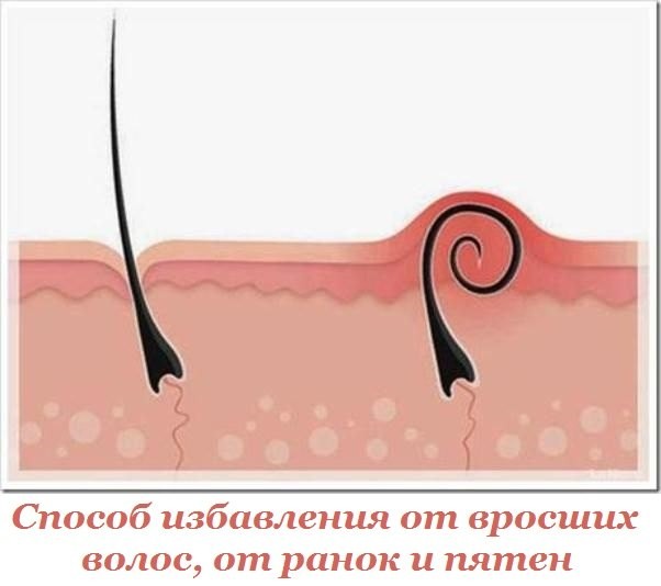 Способ избавления от вросших волос, от ранок и пятен, которые остаются на теле