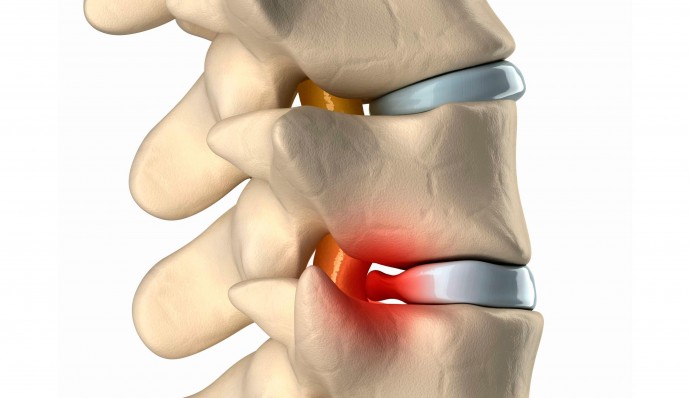 ​Полезные упражнения при межпозвоночной грыже