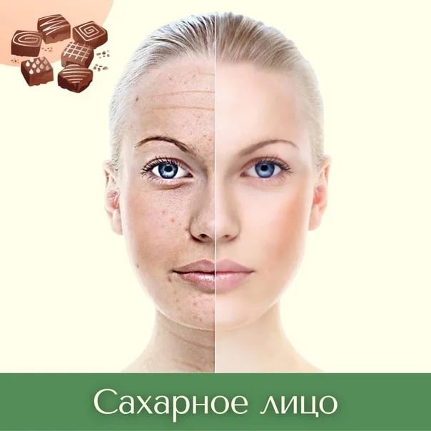 "Сахарное лицо": как сладкое влияет на внешность и кожу "Сахарное лицо": как сладкое влияет на внешность и кожу