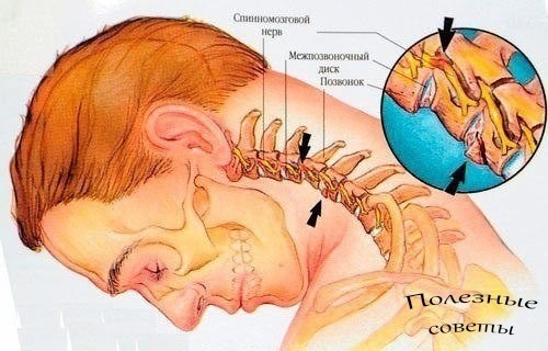 ​Если у вас болит шея