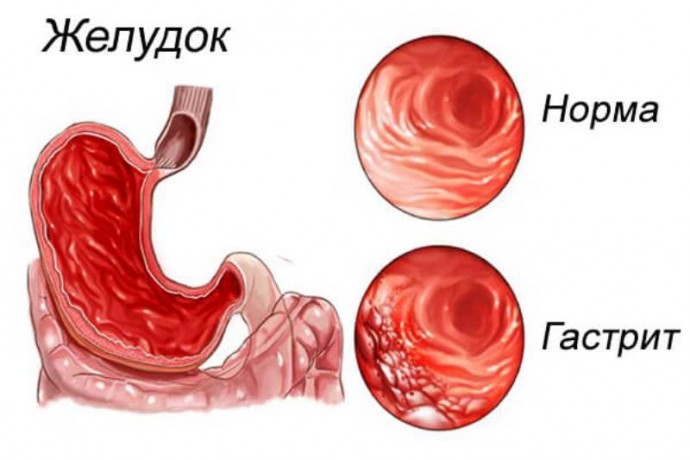 Какая еда провоцирует гастрит