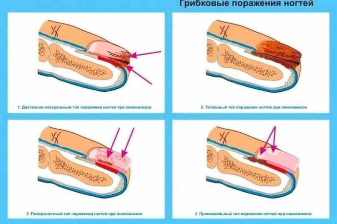 ​Как вылечить грибок на ногтях