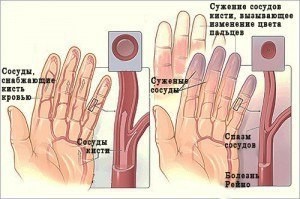 ​Народные средства против онемения рук и ног