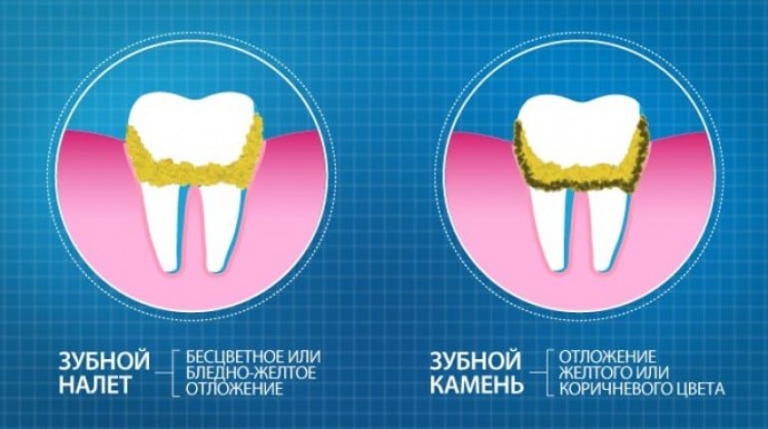 Зубной налет и камень: 13 способов, как от них избавиться