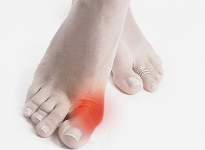 ​Профилактическое лечение подагры (косточек на ногах) с помощью обычных продуктов