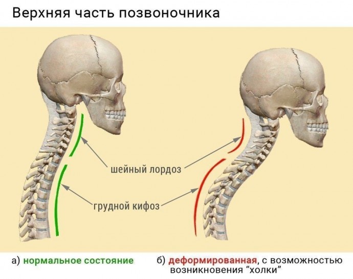 ​Как избавиться от бугорка-холки на шее