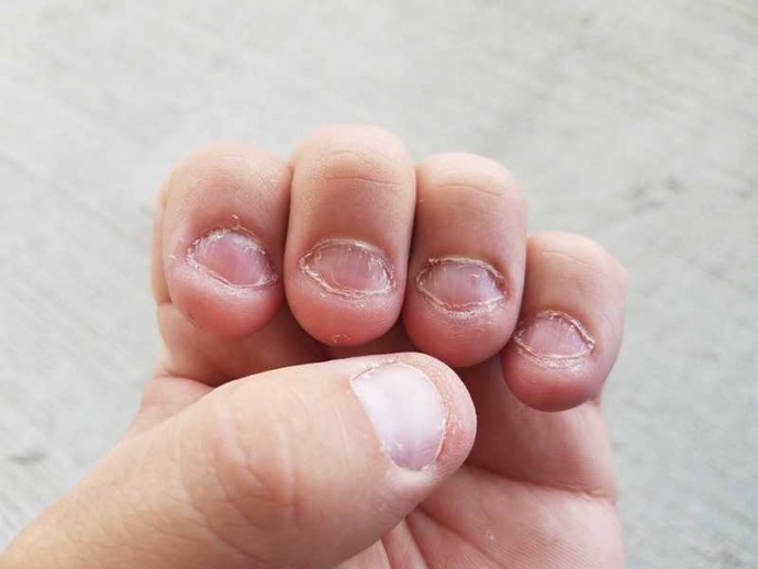 ​Как отучиться от привычки грызть ногти