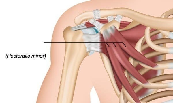 ​Малая грудная мышца или источник боли, о котором вы не догадываетесь