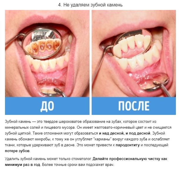 8 ошибок в уходе за зубами, которые совершает каждый из нас 8 ошибок в уходе за зубами, которые совершает каждый из нас