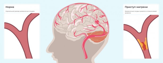 ​Список продуктов, которые могут провоцировать мигрень