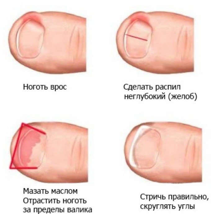 Как вылечить вросший ноготь Как вылечить вросший ноготь