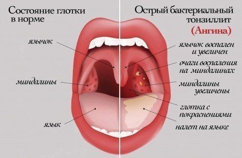 ​Профилактика ангины