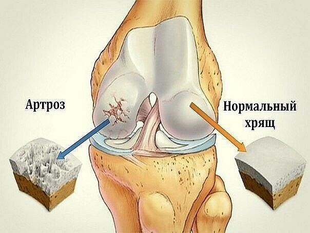 ​Профилактика проблем с коленями