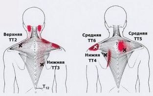 Карта точек боли в теле и точек напряжения мышц (триггеры) Карта точек боли в теле и точек напряжения мышц (триггеры)