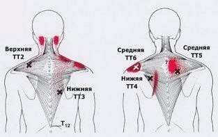 Карта точек боли в теле и точек напряжения мышц (триггеры)