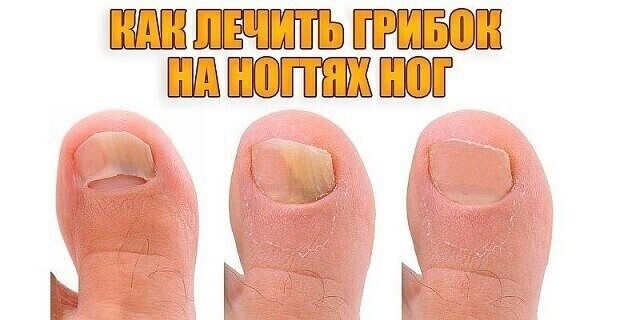 ​Как лечить грибок на ногтях ног
