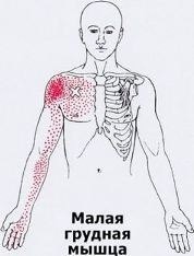 Карта точек боли в теле и точек напряжения мышц (триггеры)