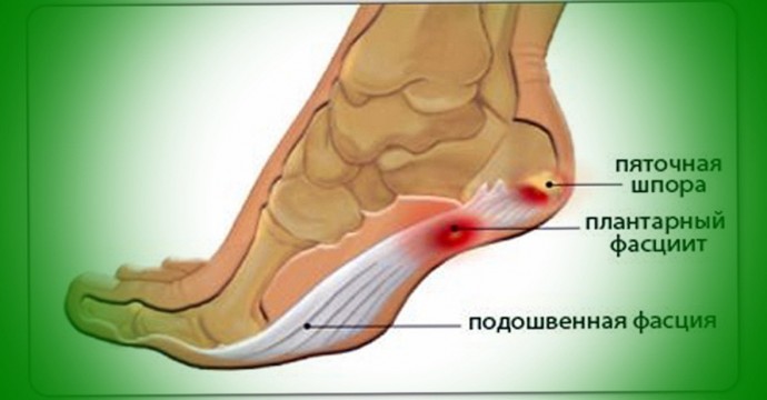 ​Профилактическое лечение пяточной шпоры