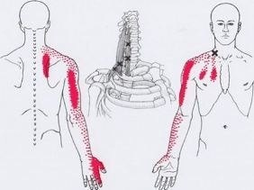 Карта точек боли в теле и точек напряжения мышц (триггеры)