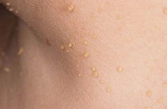 ​Народные средства от вируса папилломы