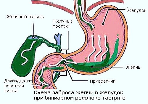 Чтобы желчный рефлюкс не беспокоил