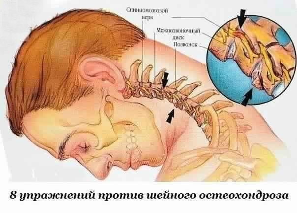 Восемь упражнений против шейного остеохондроза.